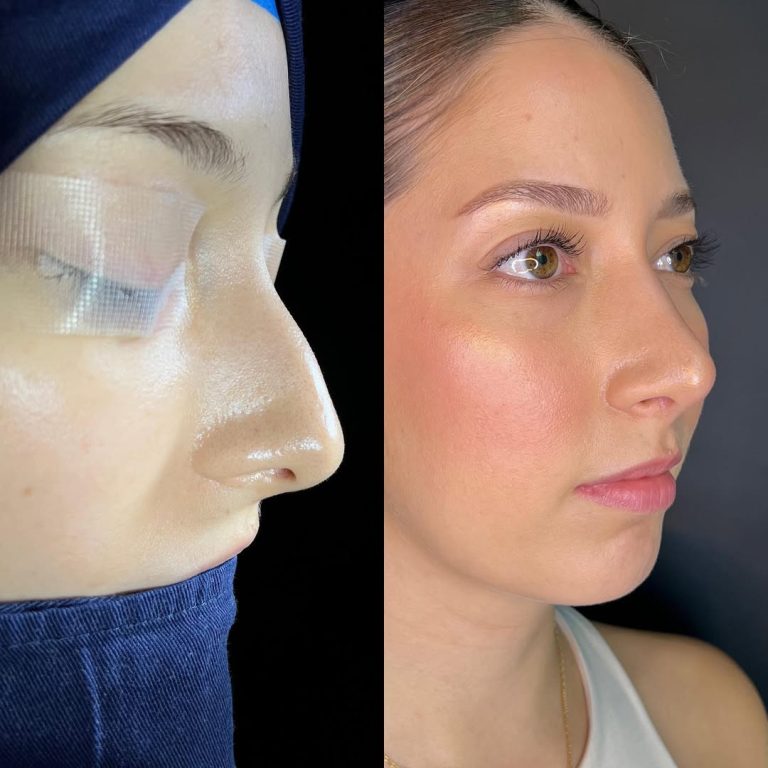 Pos Operatorio Rinoplastia 6 meses 👃🏼Así va la evolución del Pos Operatorio de Rinoplastia de